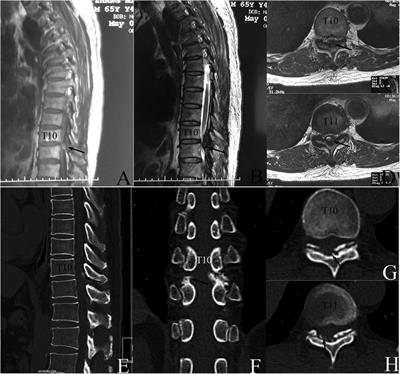 Successful treatment of thoracic myelopathy caused by spontaneous spinal epidural hematoma (SSEH) combined with calcification of the ligamentum flavum (CLF) by posterior percutaneous endoscopic surgery (PPES): A case report